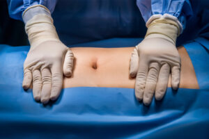 Person getting ready for hernia repair surgery